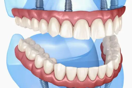 Illustration of All-on-4 dental implants showing full arch teeth restoration at Lara Smile Dental Clinic.