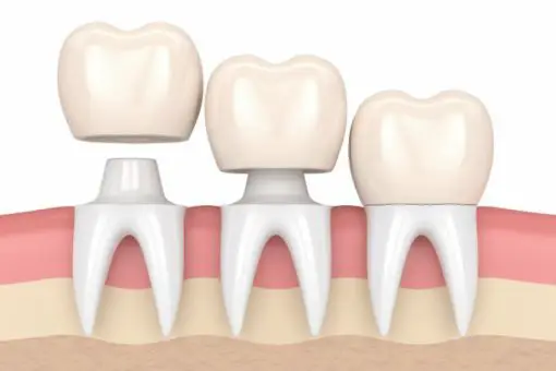 "Illustration of dental crowns placement showing how crowns fit over natural teeth at Lara Smile Dental Clinic.