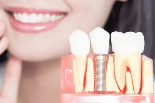 Close-up of dental implants model with a smiling patient in the background at Lara Smile Dental Clinic.