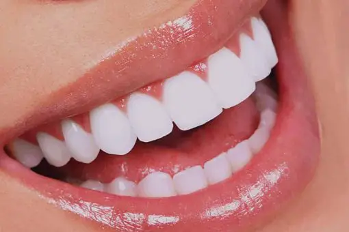 Close-up of perfectly white teeth after professional teeth whitening at Lara Smile Dental Clinic.