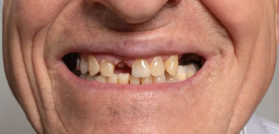 The Best Permanent Option for Missing Teeth