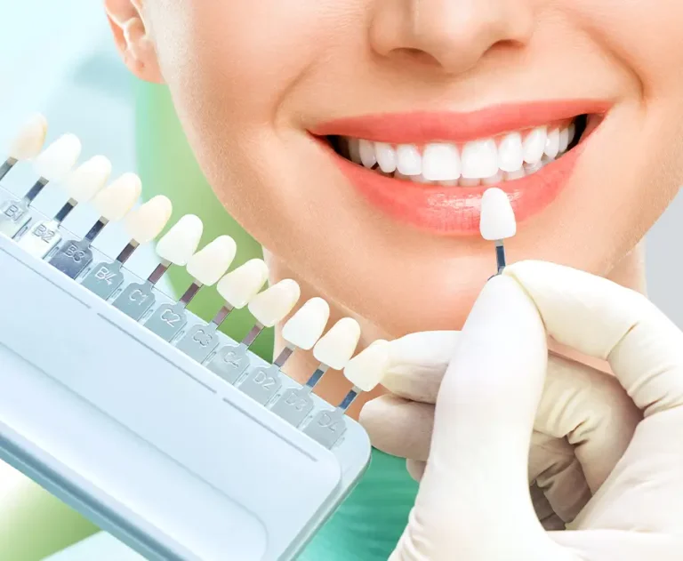 Porcelain Veneers