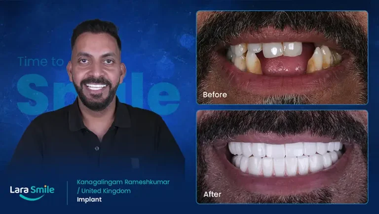 Before & After - Dental Implant