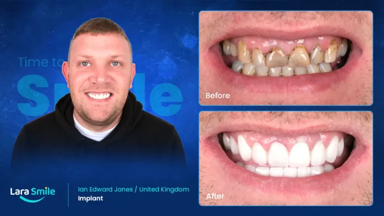 Dental Implant - Zirconium Crown - Lara Smile