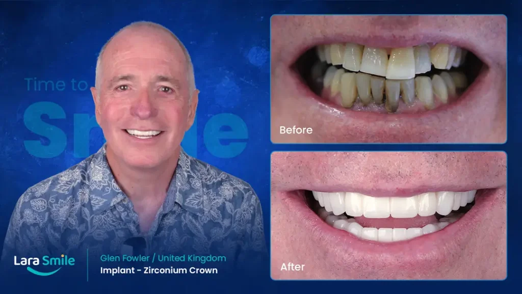 Glen Fowler - Implants & Zirconium Crowns