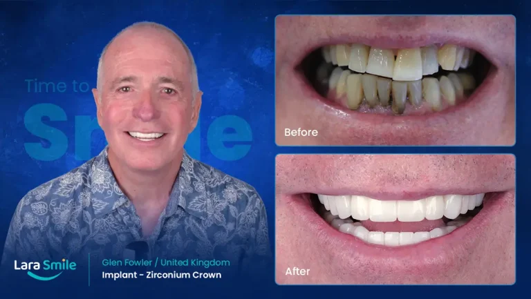 Dental Implant - Zirconium Crown - Lara Smile