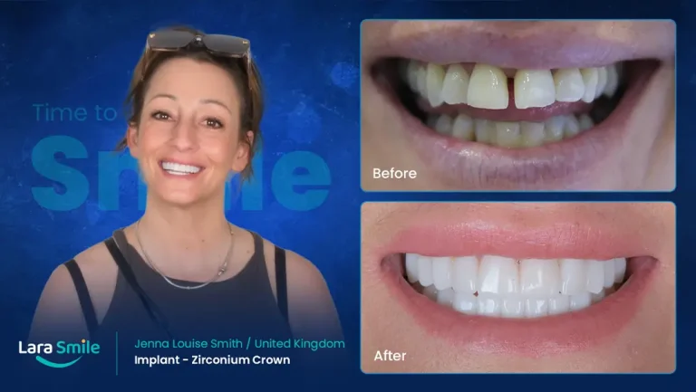 Jenna Smith - Implants & Zirconium Crowns