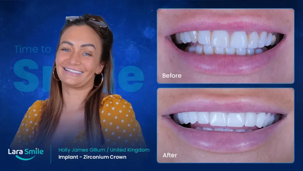 Dental Implant - Zirconium Crown - Lara Smile
