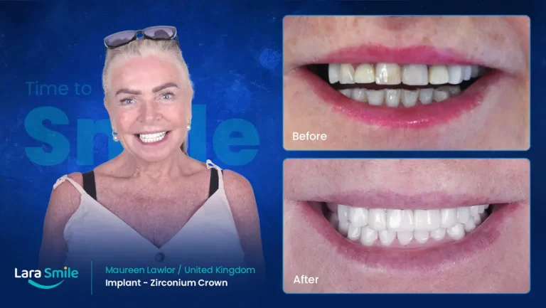 Dental Implant - Zirconium Crown - Lara Smile