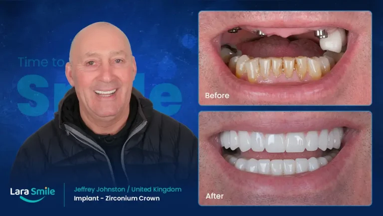 Dental Implant - Zirconium Crown - Lara Smile