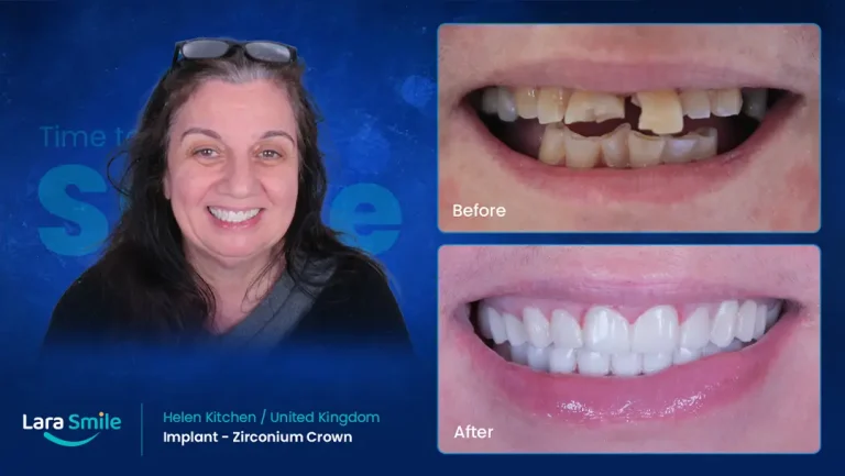 Dental Implant - Zirconium Crown - Lara Smile