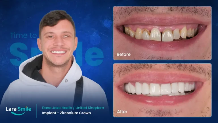 Dental Implant - Zirconium Crown - Lara Smile