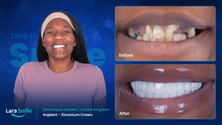 Dental Implant - Zirconium Crown - Lara Smile