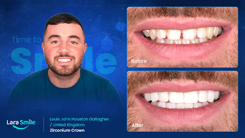 Before & After - Zirconium Crown