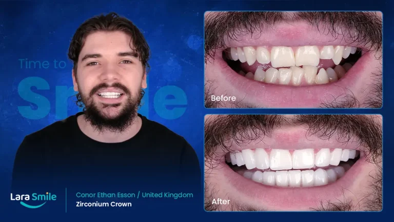 Zirconium Crowns - Conor Esson - United Kingdom