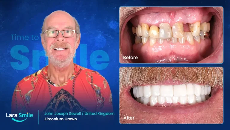 Zirconium Crowns - Joseph Sewell - United Kingdom
