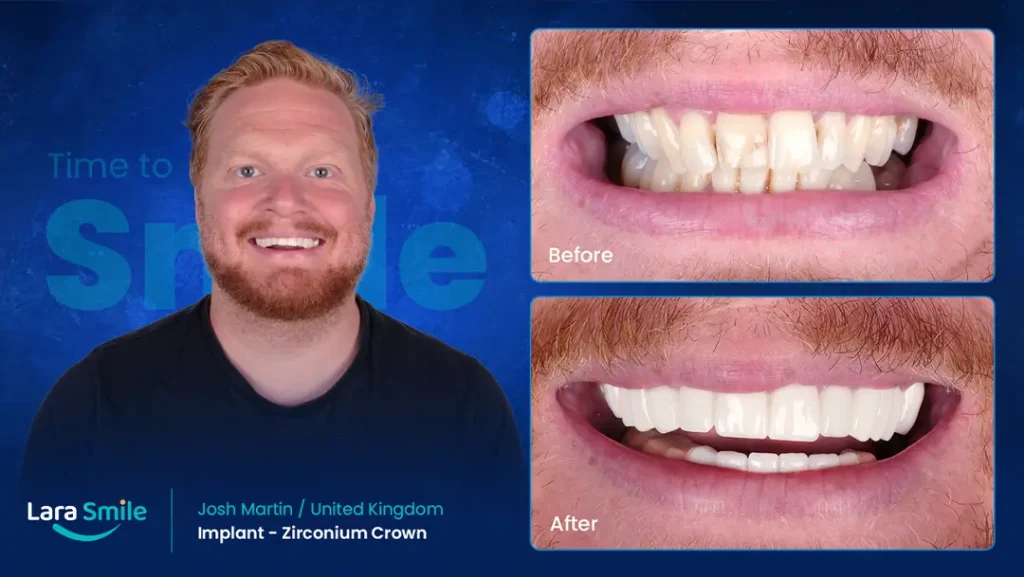 Zirconium Crowns - Josh Martin - United Kingdom