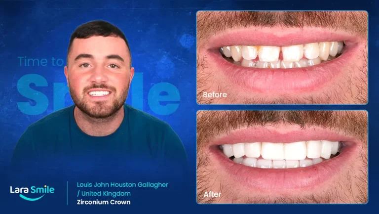 Zirconium Crowns - Louis Gallager - United Kingdom