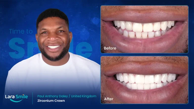 Zirconium Crowns - Paul Daley - United Kingdom