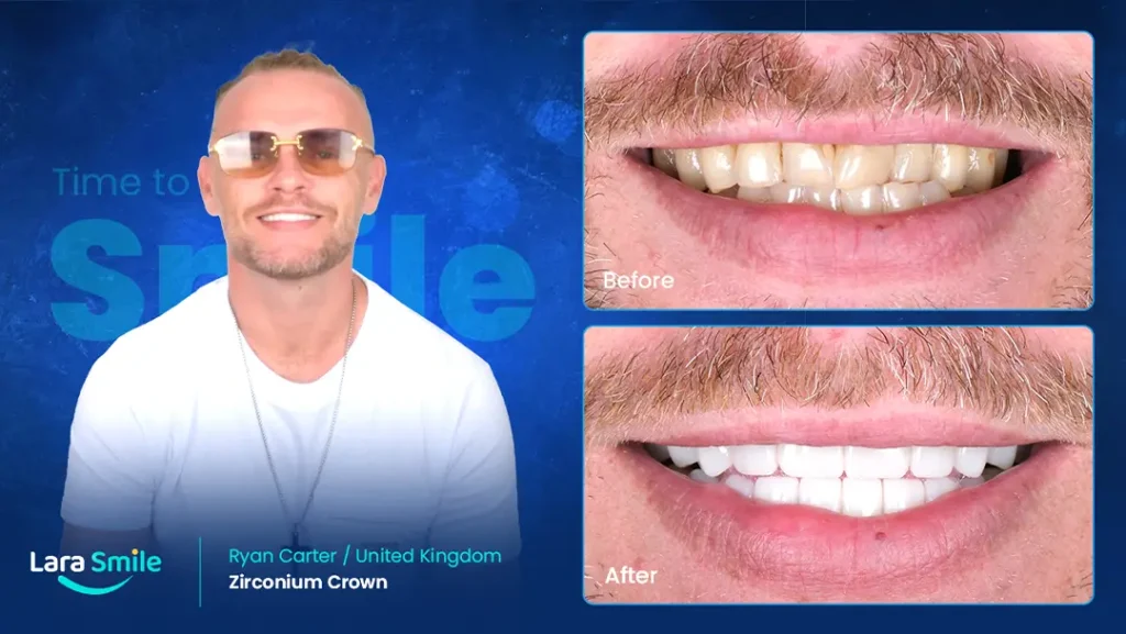 Zirconium Crowns - Ryan Carter - United Kingdom