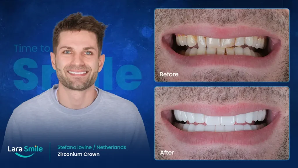 Zirconium Crowns-StefanoLovine -Before & After