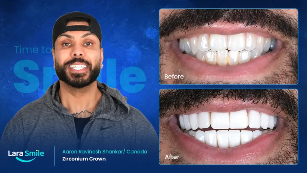 Zirconium Crowns - Aaron Shankar - USA