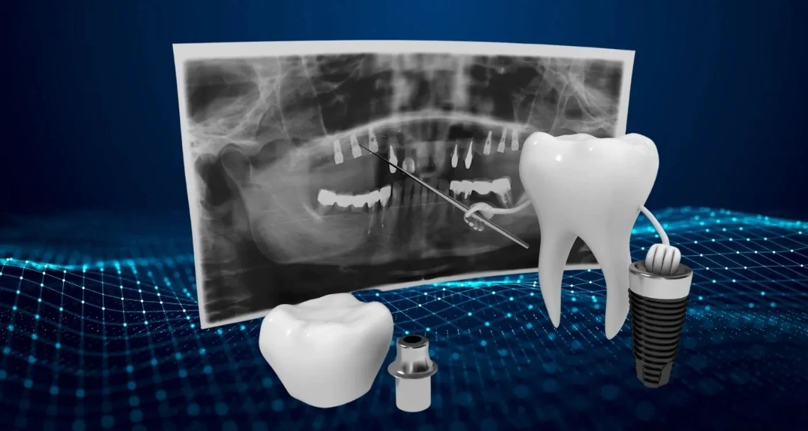 3D illustration showing a dental implant, implant components, and a panoramic dental X-ray representing digital implant planning and modern implant dentistry.