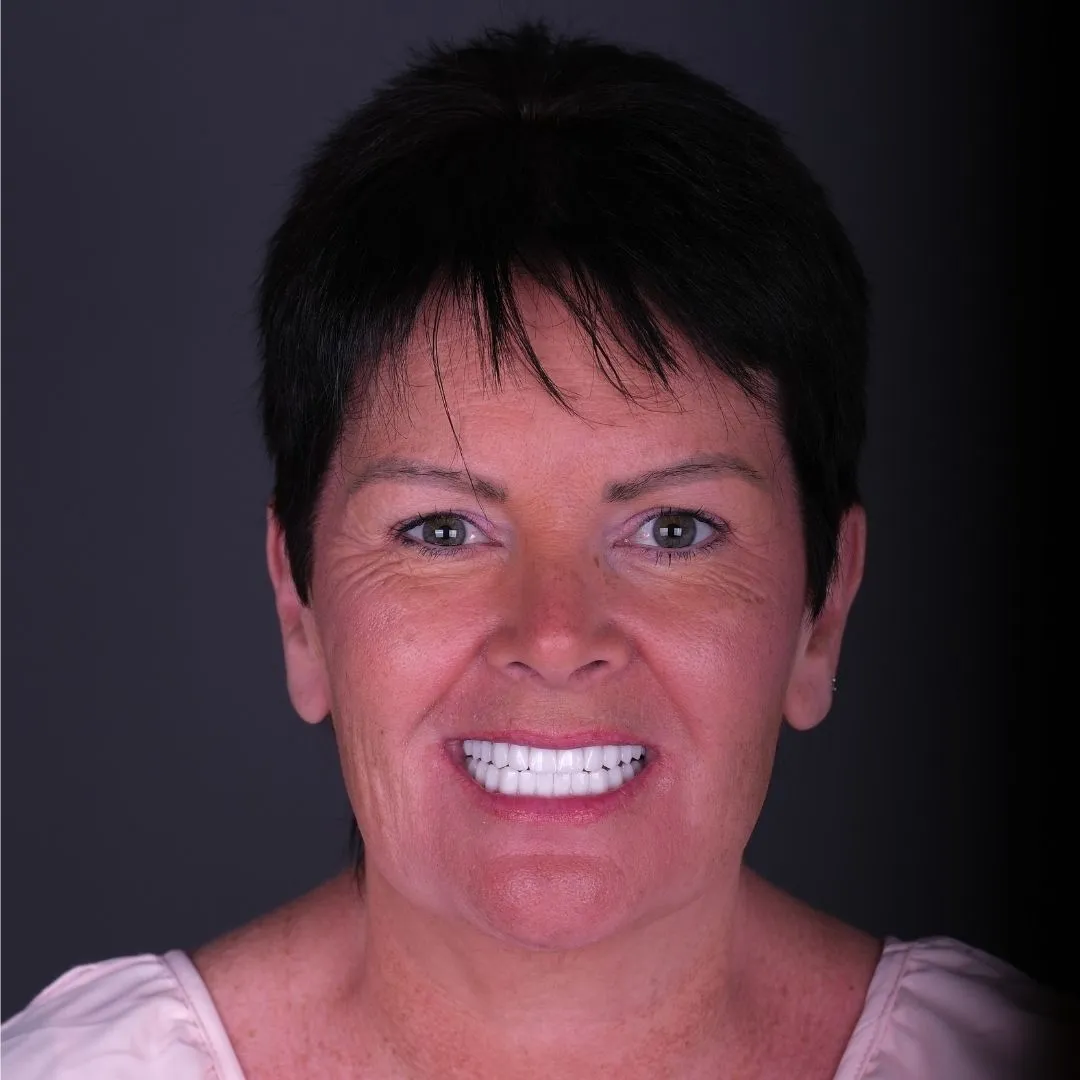 All-on-4 Dental Implants treatment