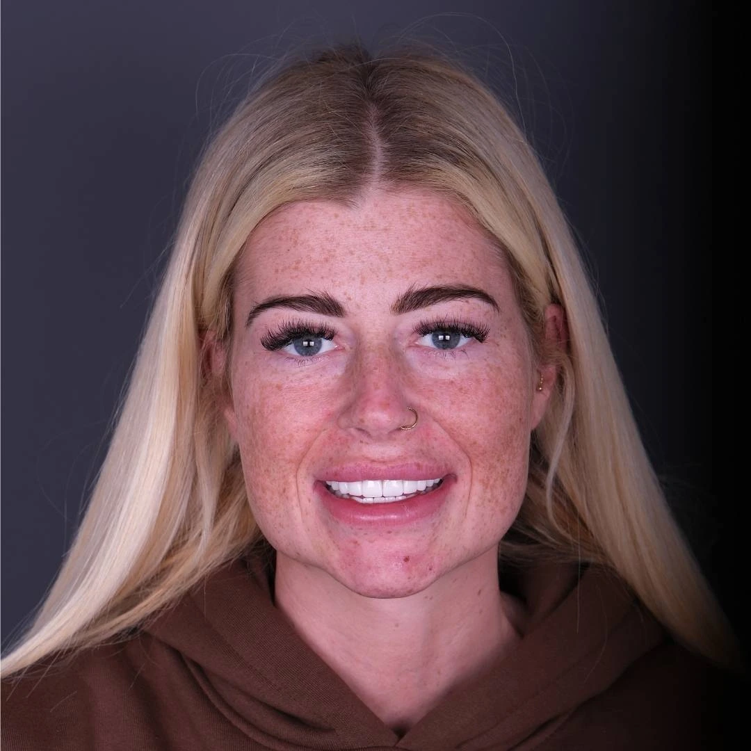 Dental crowns treatment