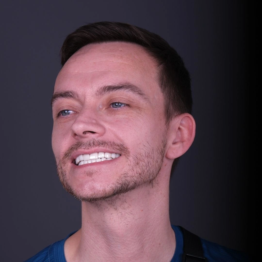 Dental veneers treatment