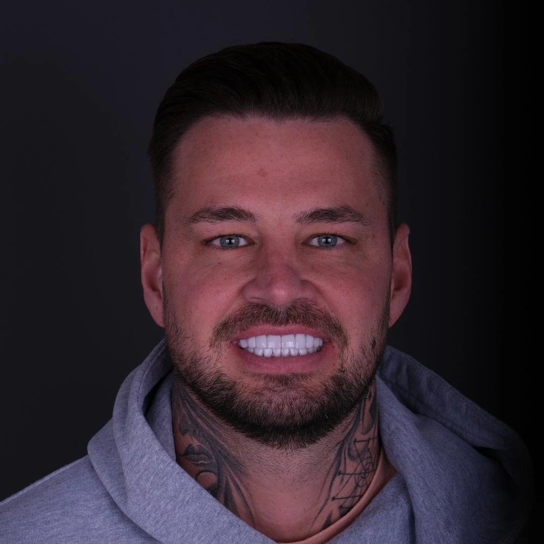 Hollywood Smile treatment