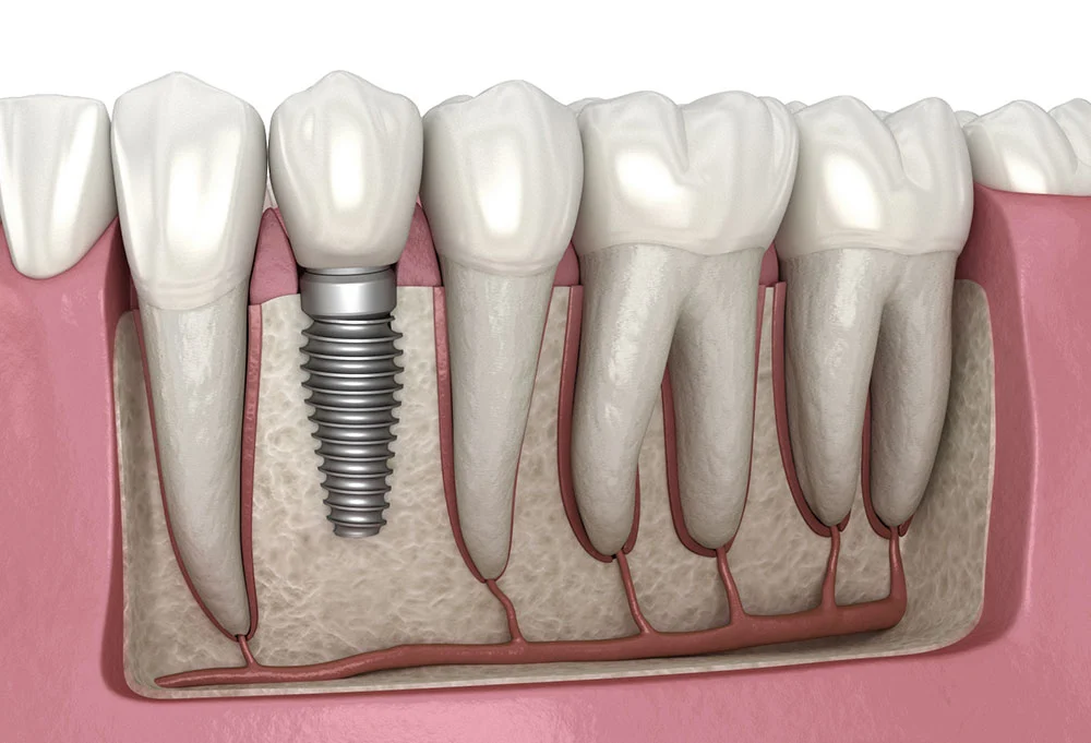 dental implants supporting multiple teeth full arch all-on-4 illustration