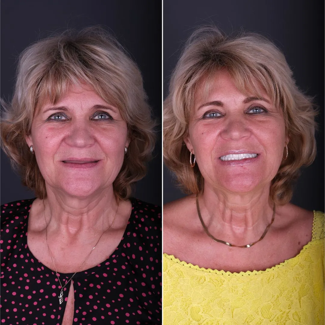 Natural-looking full arch dental implant result after All-on-8 treatment