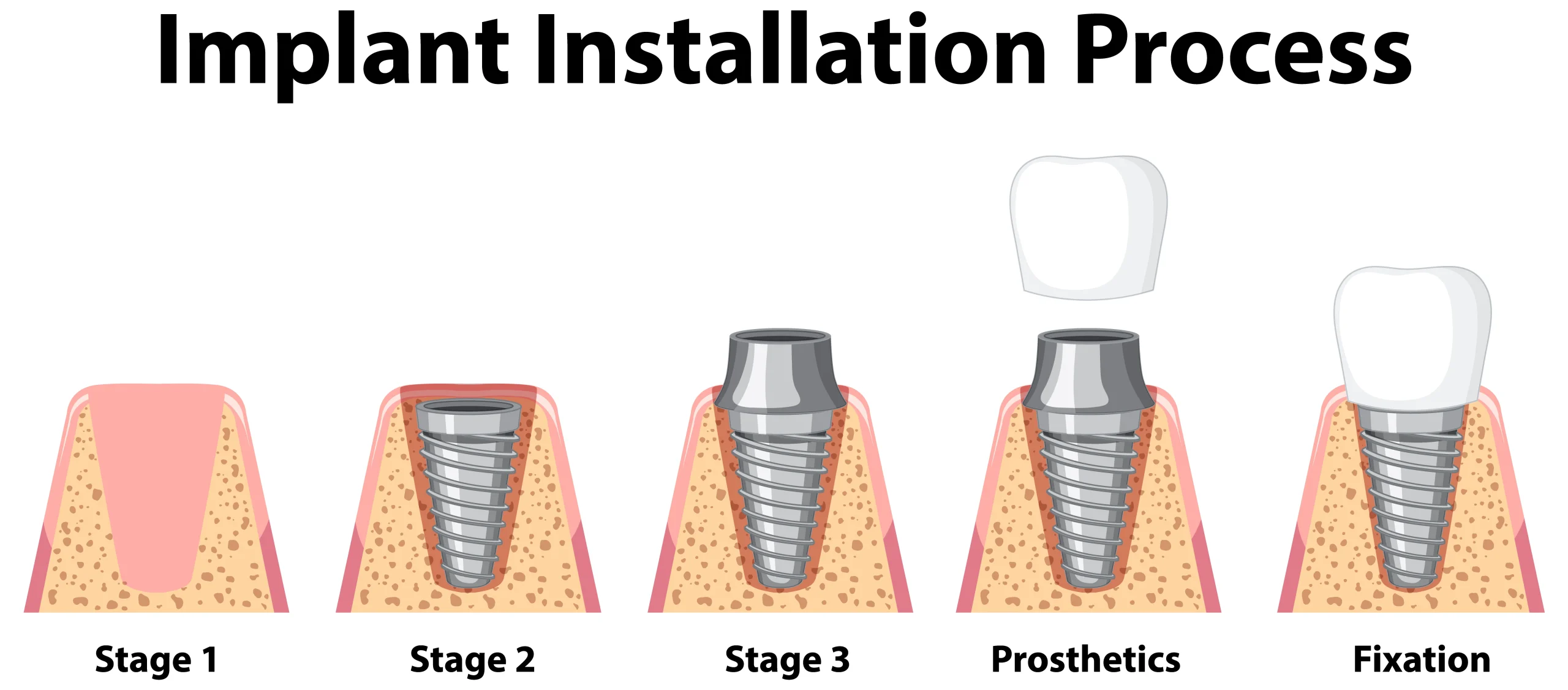 Dental implant treatment planning illustration