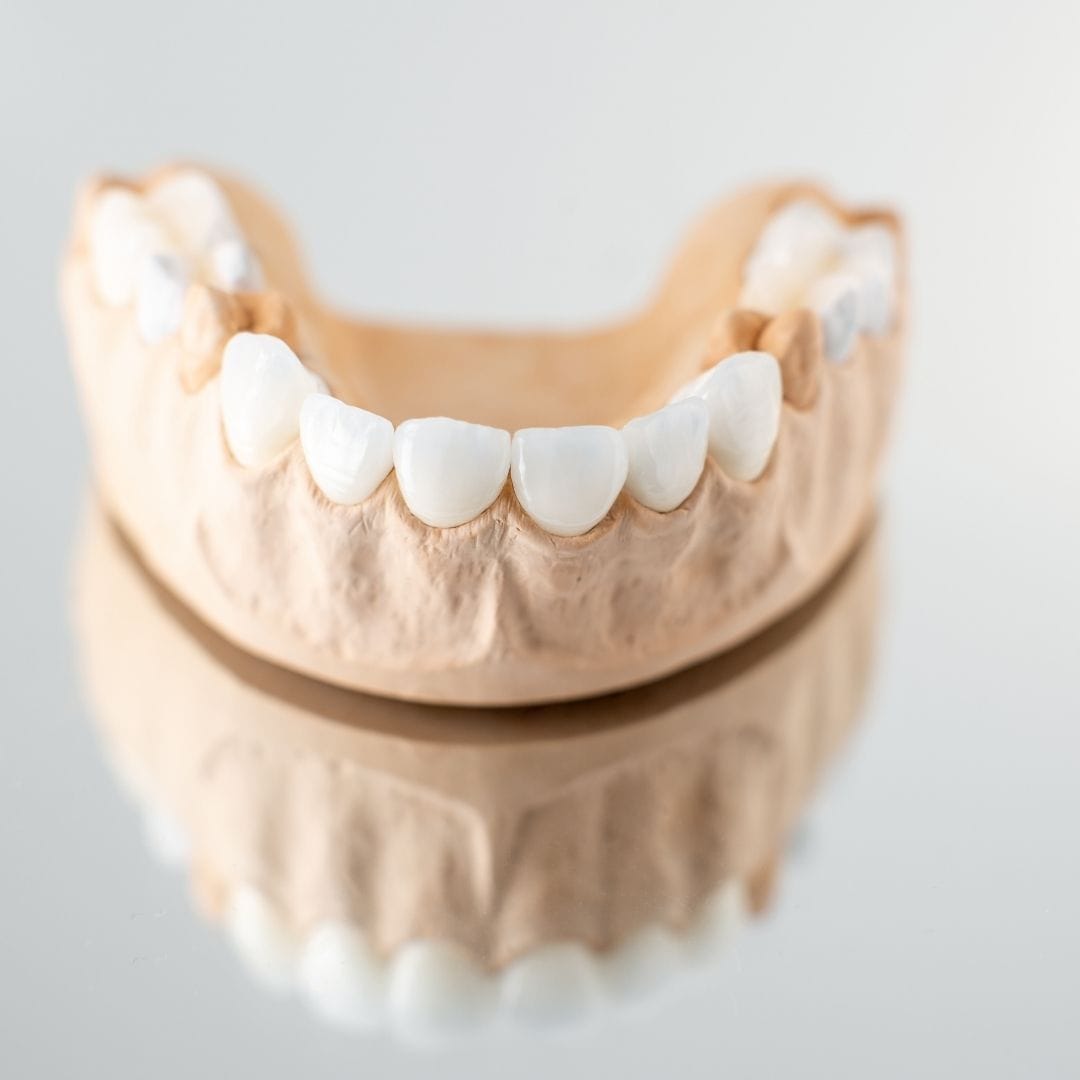 All-on-8 dental implants in Turkey full arch treatment