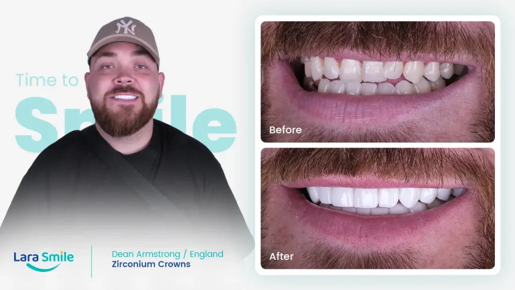 Zirconium Crowns - Dean Armstrong