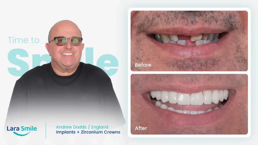 Implants & Zirconium Crowns - Andrew Dodds