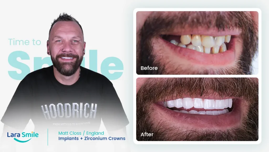 Implants & Zirconium Crowns - Matt Closs