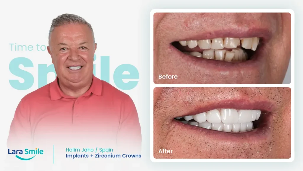 Implants & Zirconium Crowns - Halim Jaho