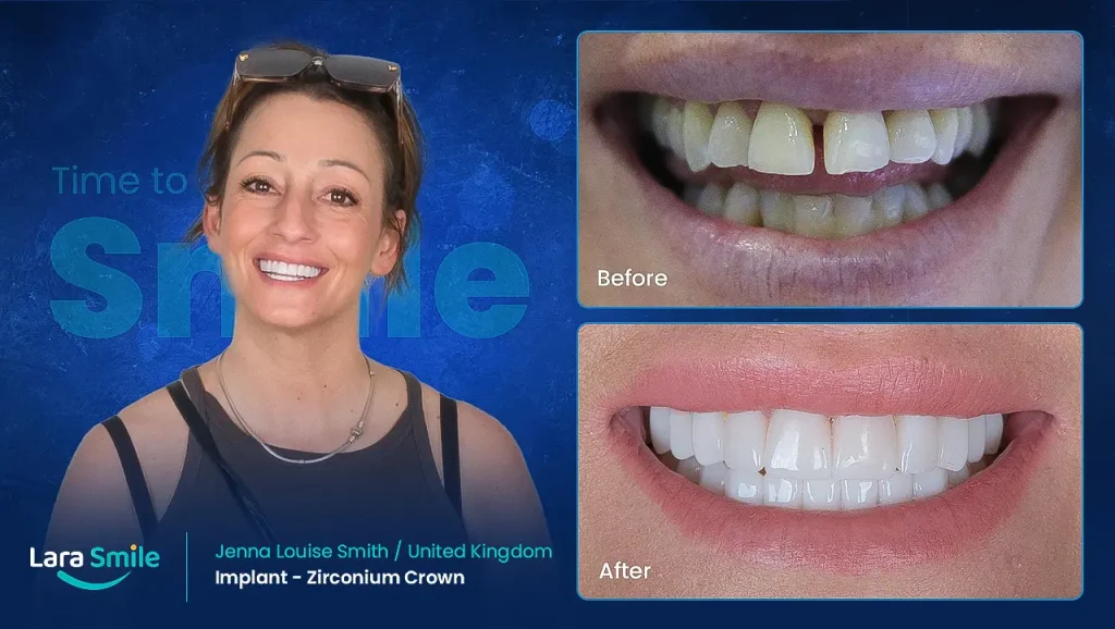 Implants & Zirconium Crowns - Jenna Smith