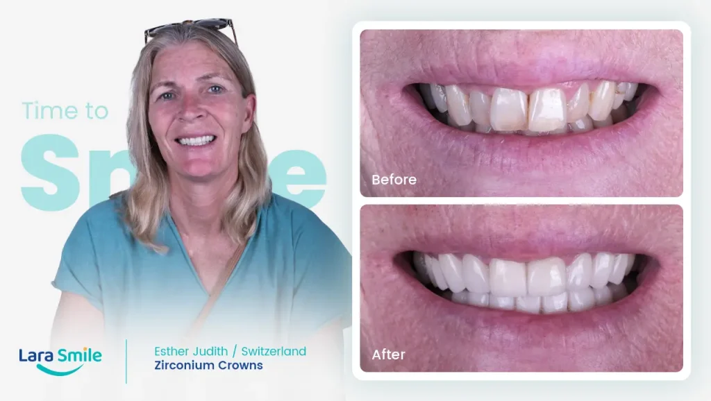 Zirconium Crowns - Esther Judith
