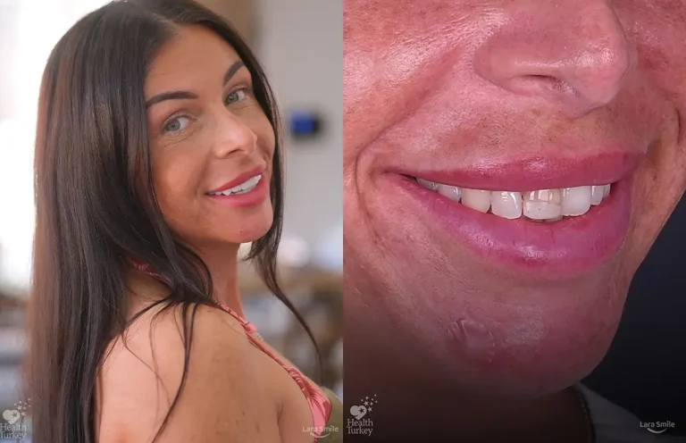 Veneers & Smile Makeovers in Antalya
