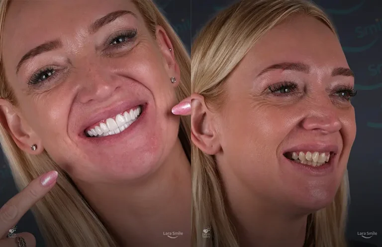 Veneers & Smile Makeovers in Antalya
