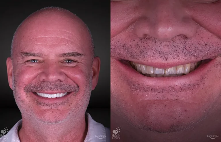 Dental Implants in Antalya, Turkey