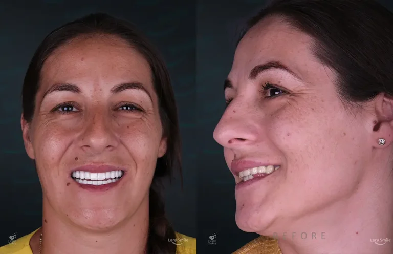 Dental Implants in Antalya, Turkey