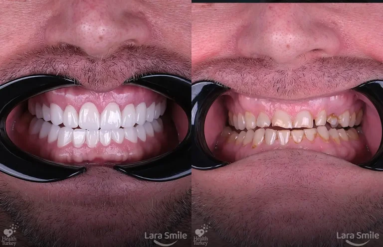 Dental Implants in Antalya, Turkey