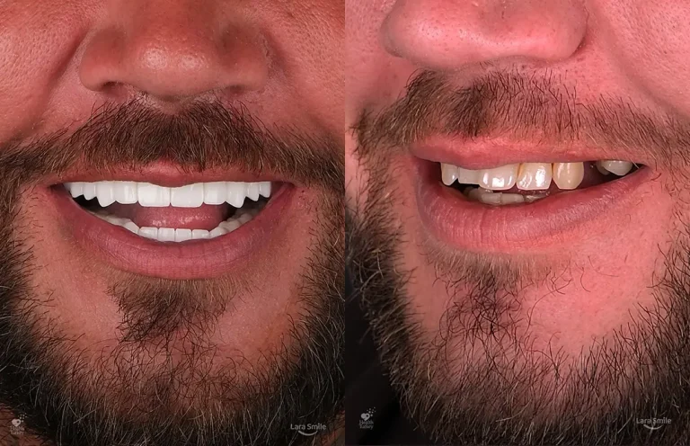 Dental Implants in Antalya, Turkey
